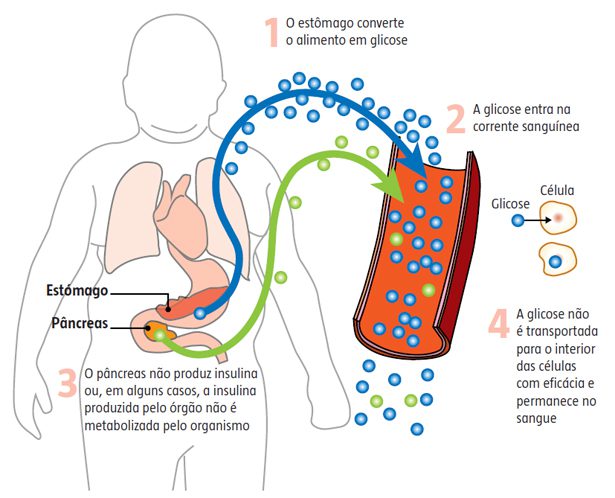 diabetes-ja-atinge-um-milhao-de-criancas-no-brasil-A
